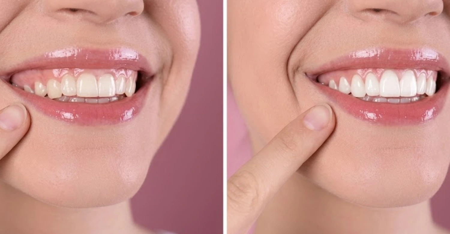 Laser Gum Reshaping vs Traditional Gingivectomy 2